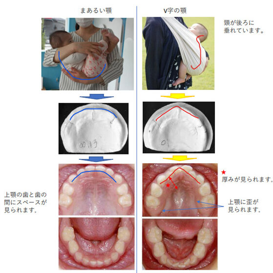 赤ちゃん歯科資料（抱っこ例）