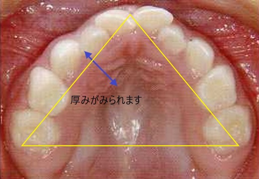 口呼吸の結果、三角の顎に育ったしまった上顎