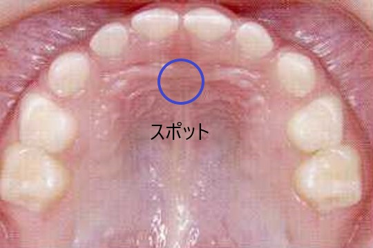口腔内におけるスポットの位置