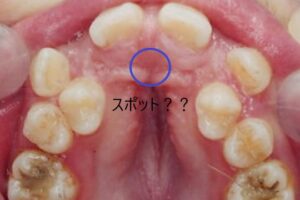 口腔内におけるスポット？