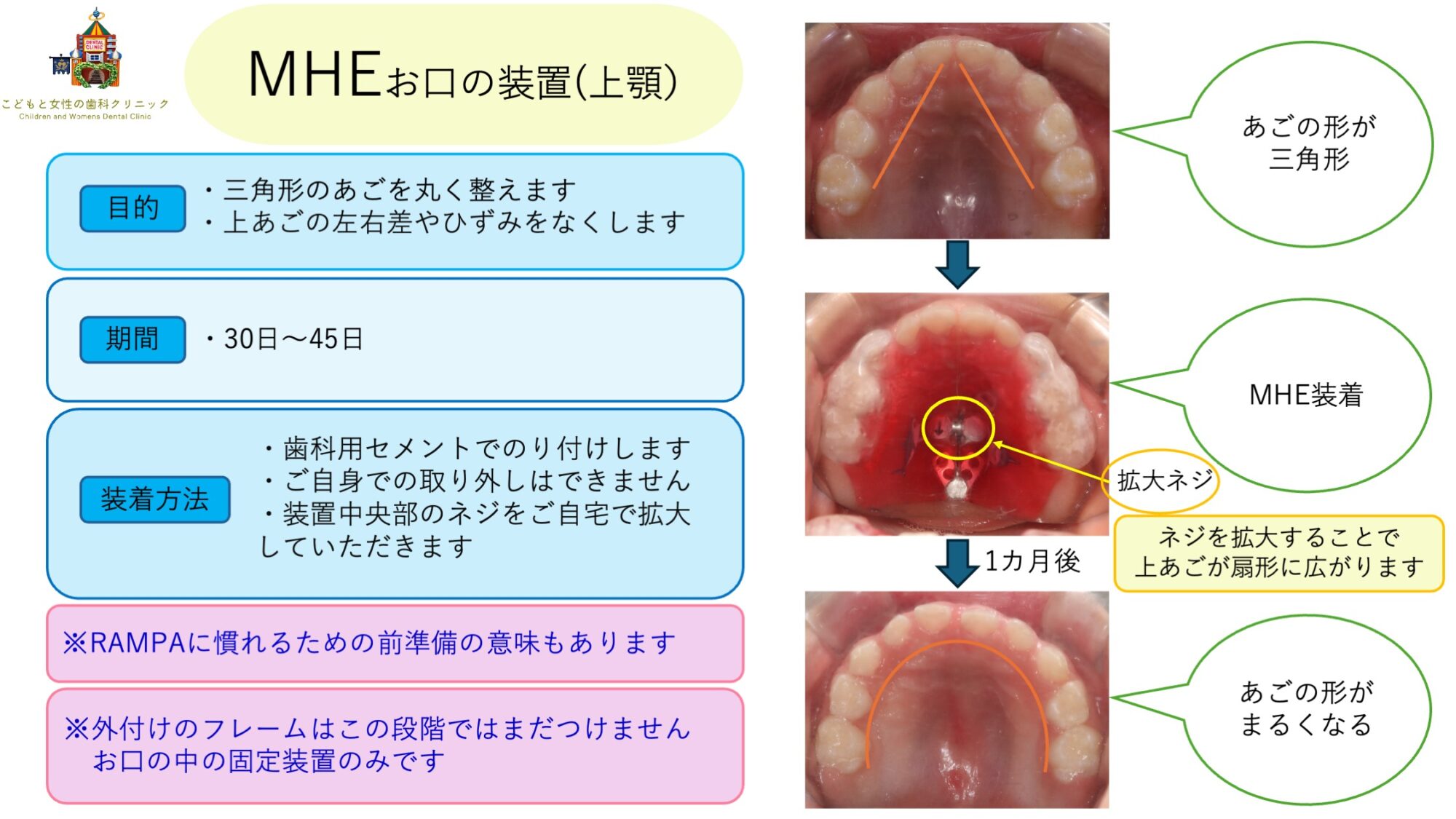 RAMPAの装置（MHE)