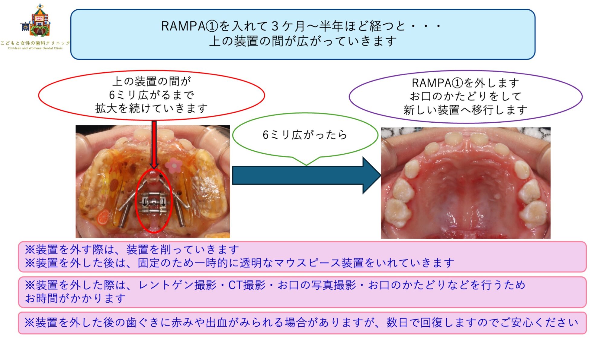 RAMPAの装置