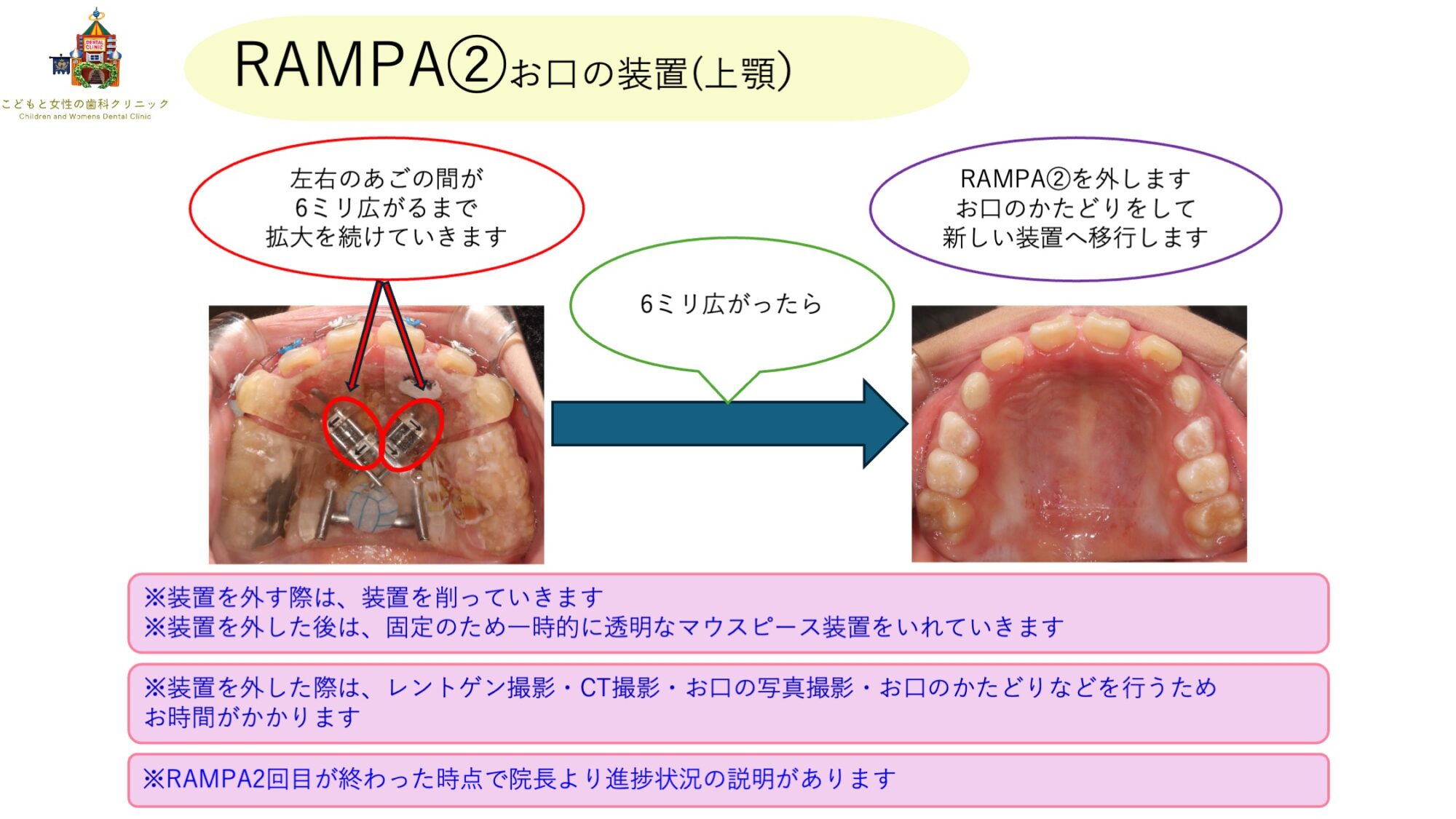 RAMPAの装置