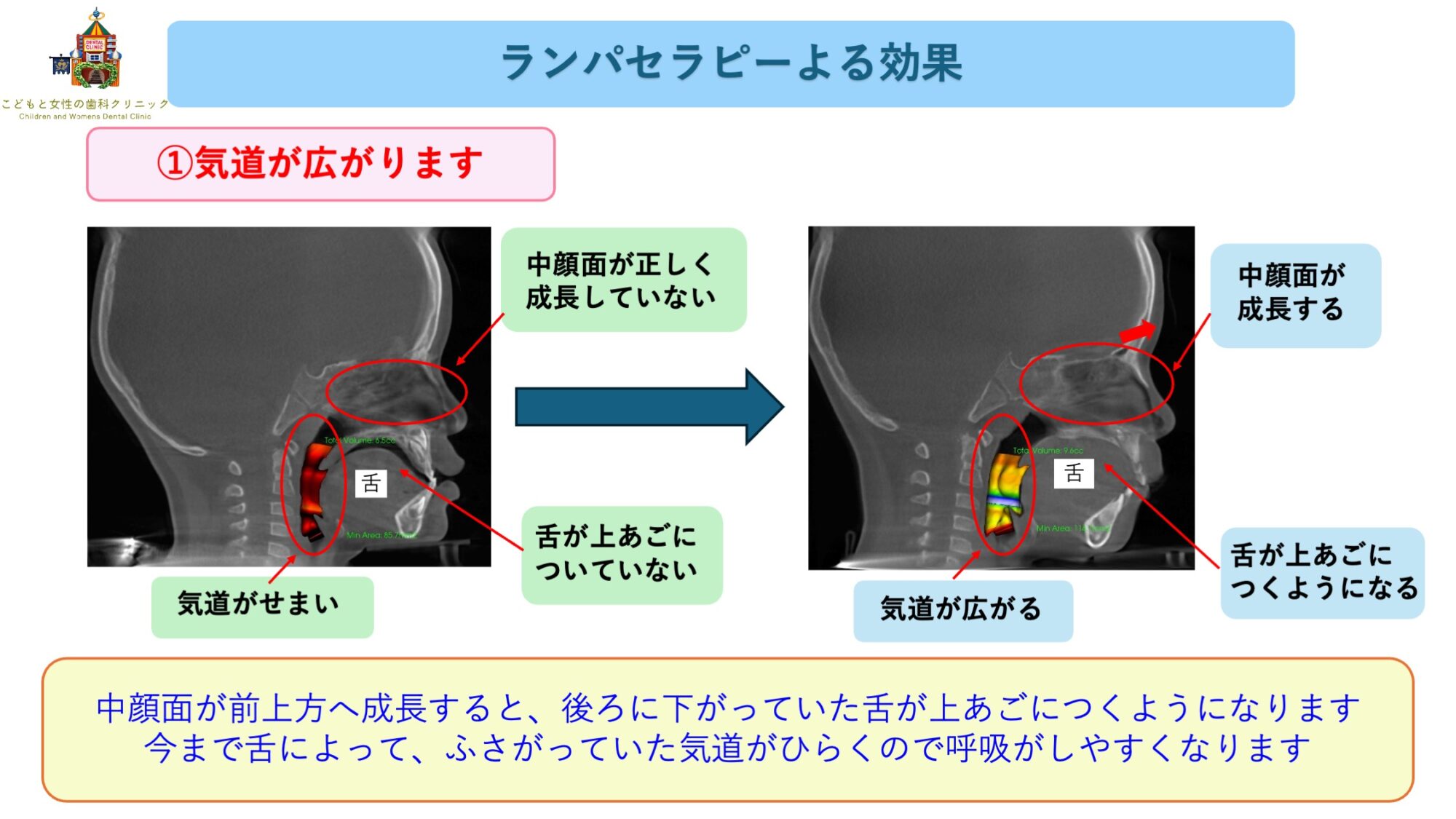こどもと女性の歯科クリニック ランパセラピーの効果(気道容積拡大)