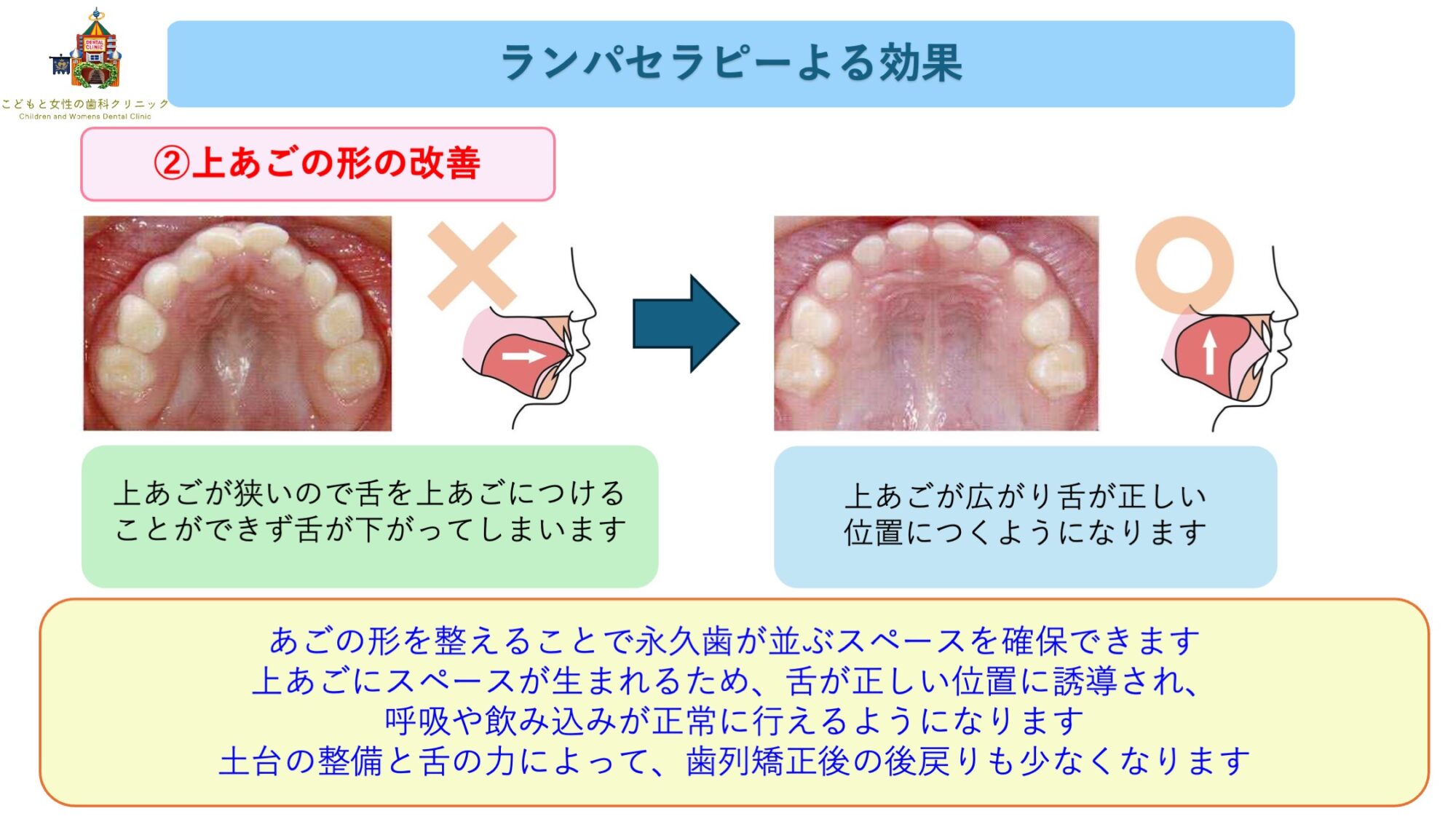 こどもと女性の歯科クリニック ランパセラピーの効果(上顎の形の改善)