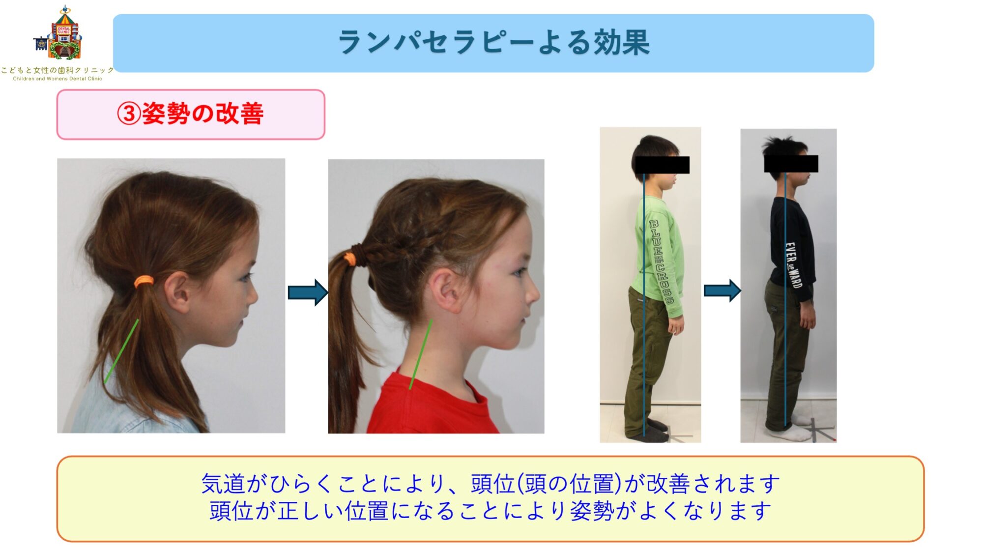 こどもと女性の歯科クリニック ランパエラピーの効果(姿勢の改善)
