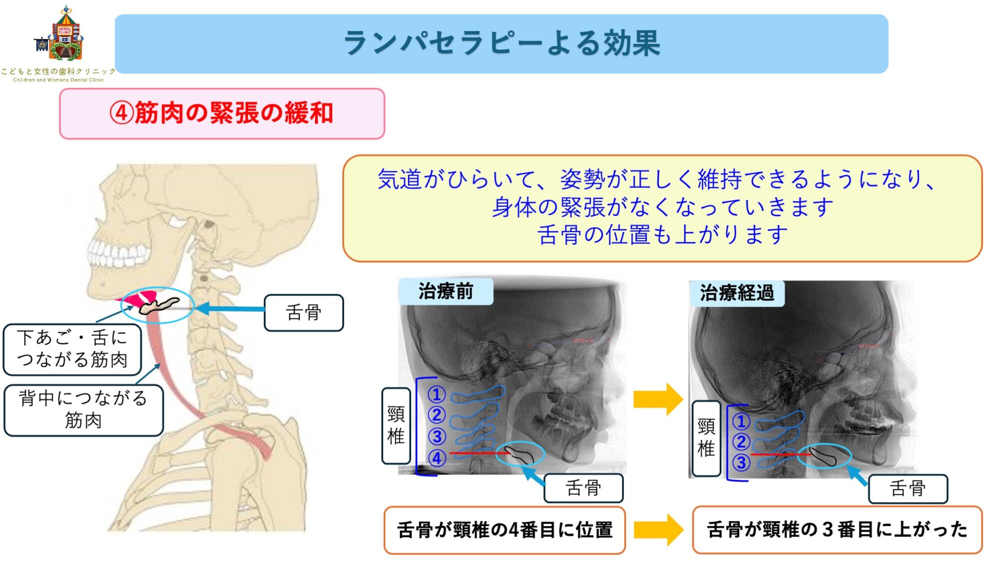 こどもと女性の歯科クリニック ランパセラピーの効果(筋肉の過緊張の緩和)
