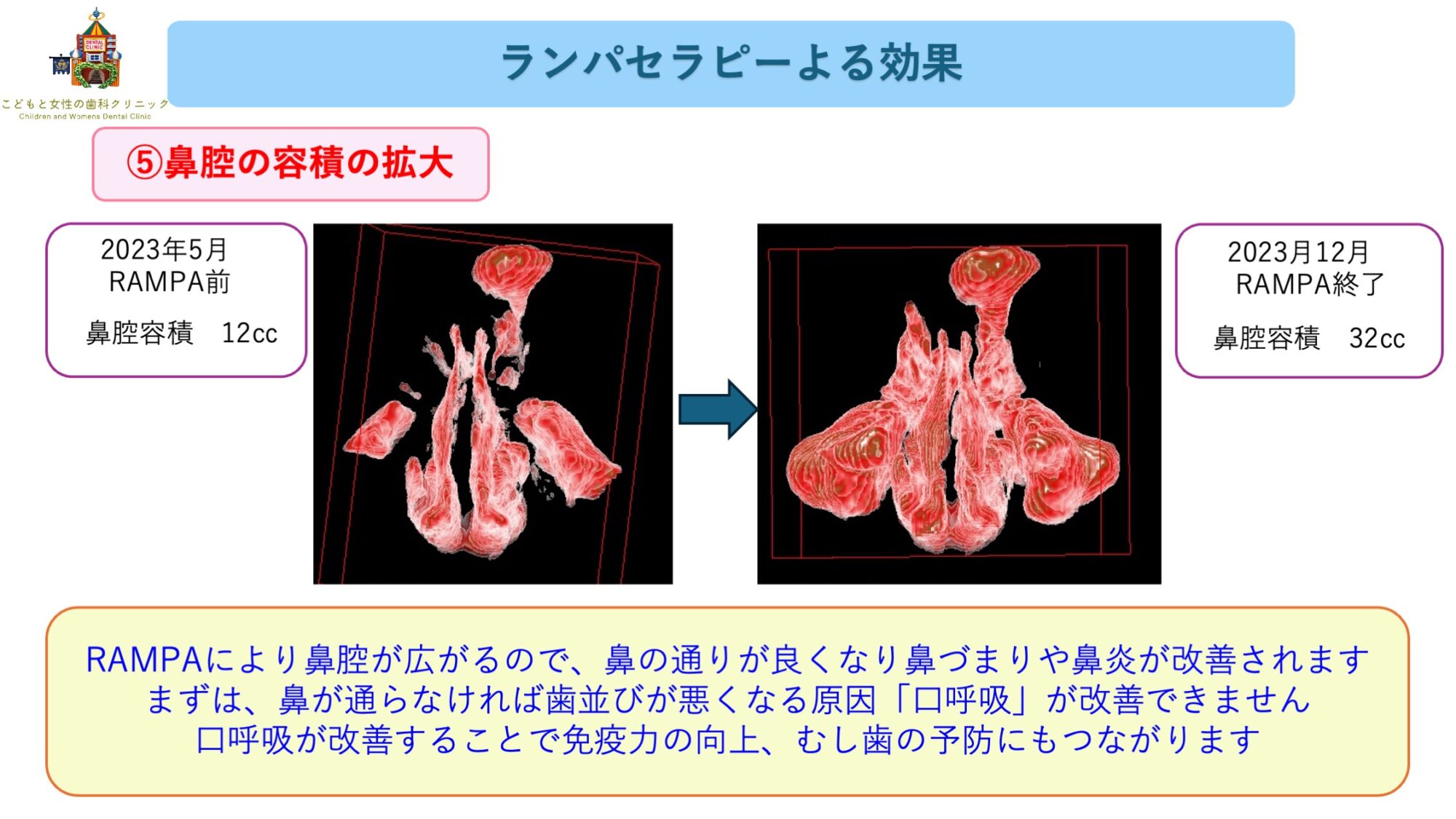 こどもと女性の歯科クリニック ランパセラピーの効果(鼻副鼻腔容積拡大)