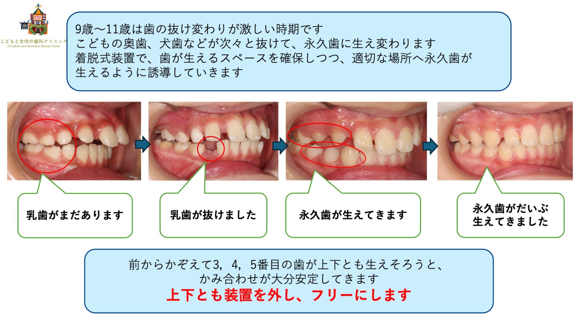 ランパセラピー（ランパ矯正）での歯列調整
