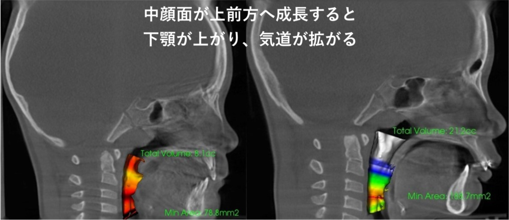 こどもと女性の歯科クリニック RAMPA前と治療中の気道容積の変化を示すレントゲン