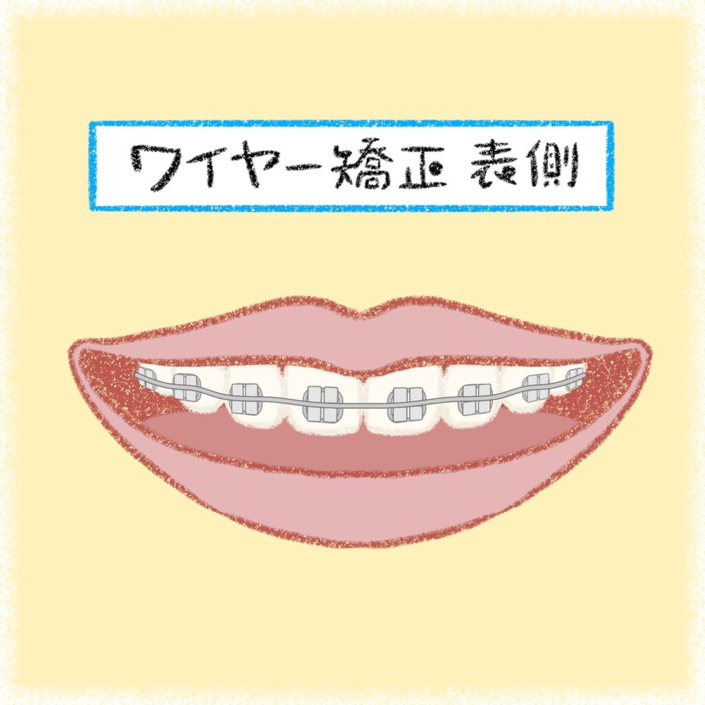 ワイヤー矯正（表側）