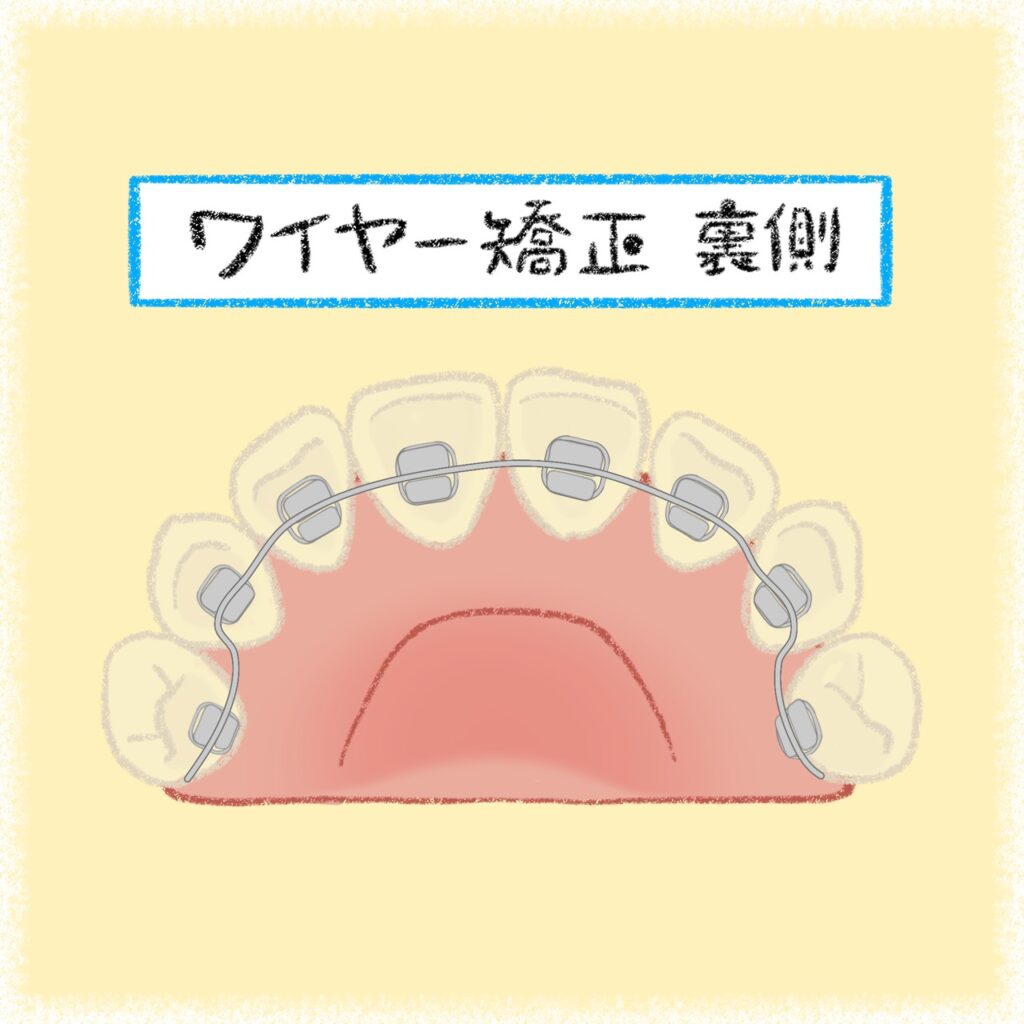 ワイヤー矯正（裏側）