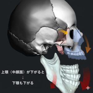 口呼吸(舌が上顎につかない)状況下での上下顎の骨格変化のイメージ
