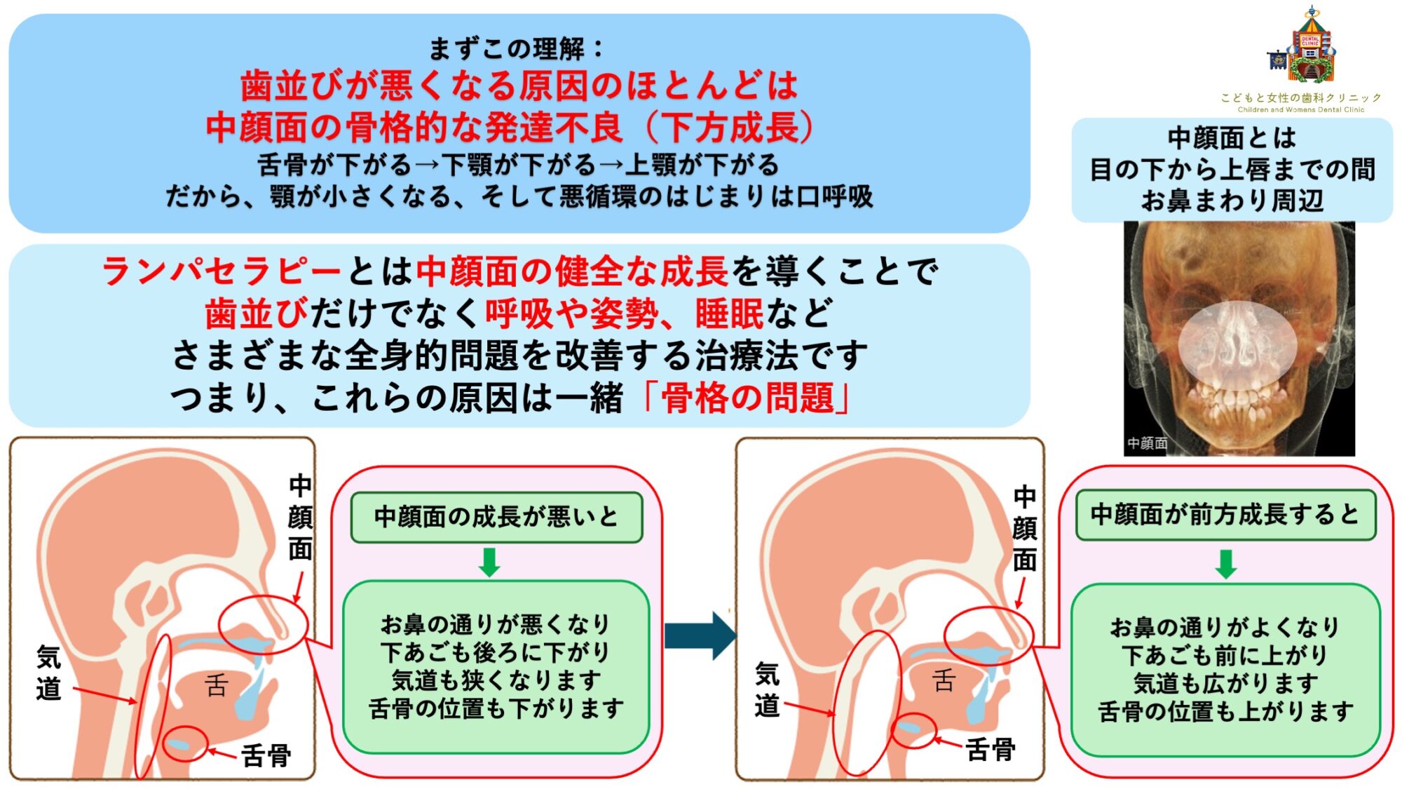 こどもと女性の歯科クリニック 中顔面の成長方向の違いによる影響