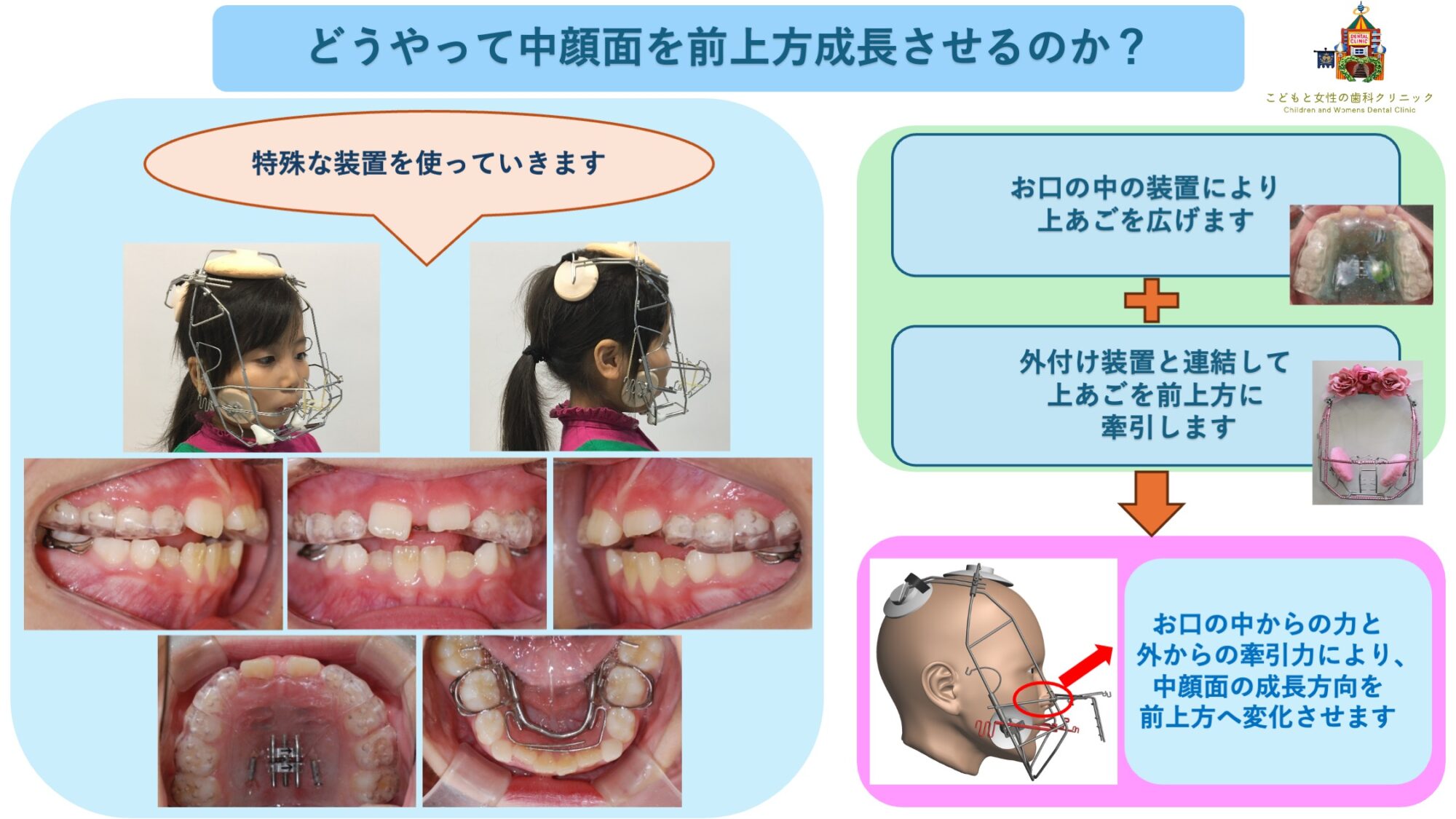 RAMPAによる中顔面の成長方向変化概要