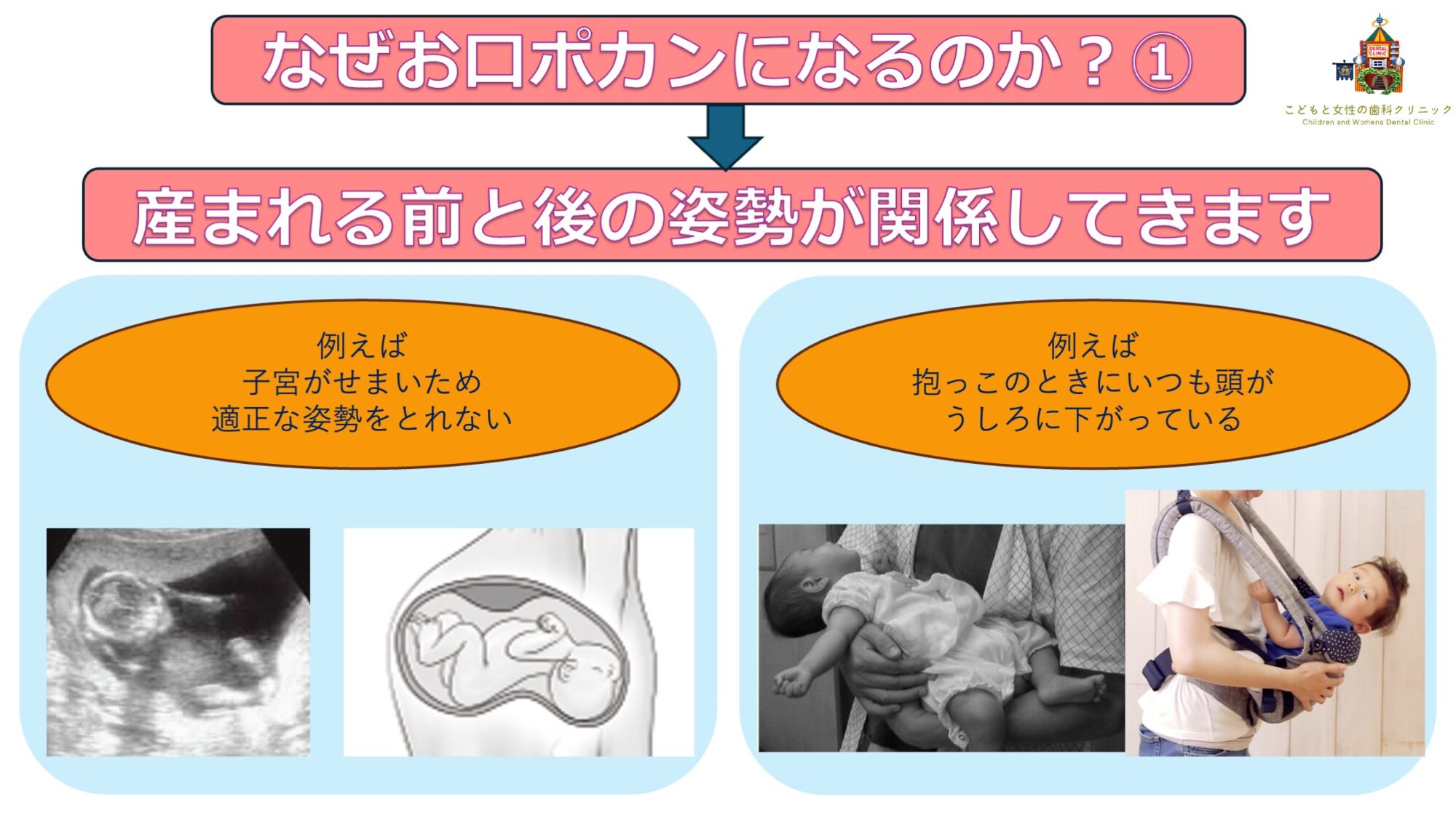 なぜお口ポカンリスト１