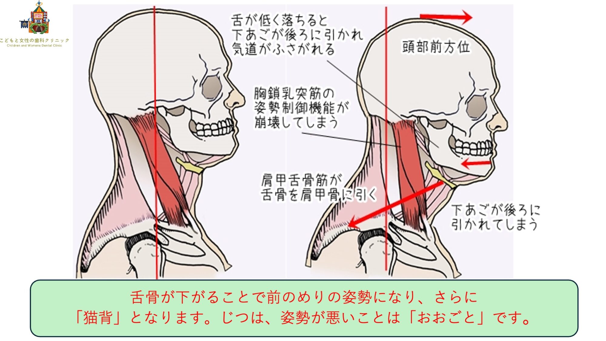 こどもと女性の歯科クリニック 姿勢が悪い(お口ポカン・口呼吸)ことでの骨格的影響