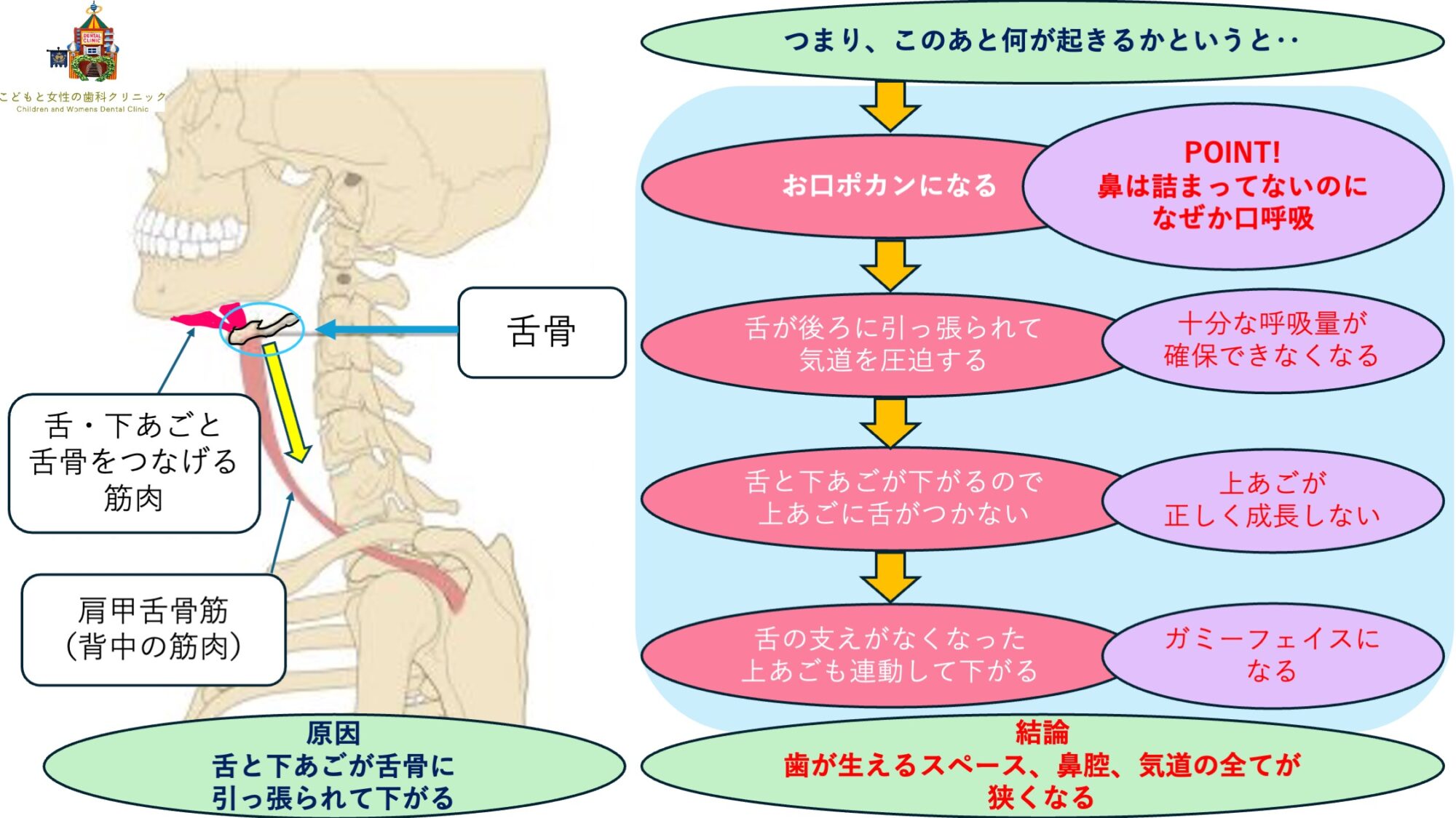 こどもと女性の歯科クリニック 舌骨が下がること(口呼吸)に連動して起こる諸症状のフロー
