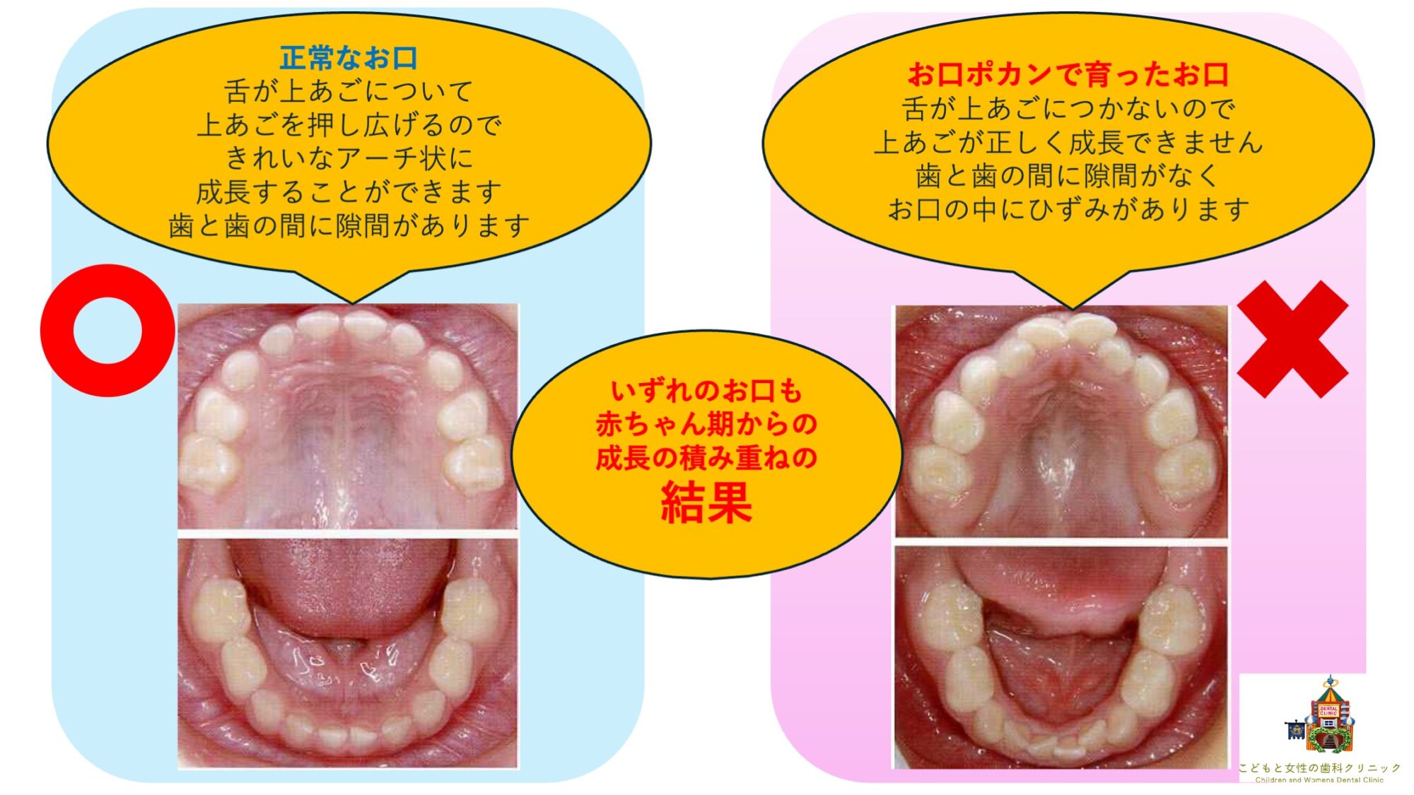 正しく成長したお口とそうではないお口の比較