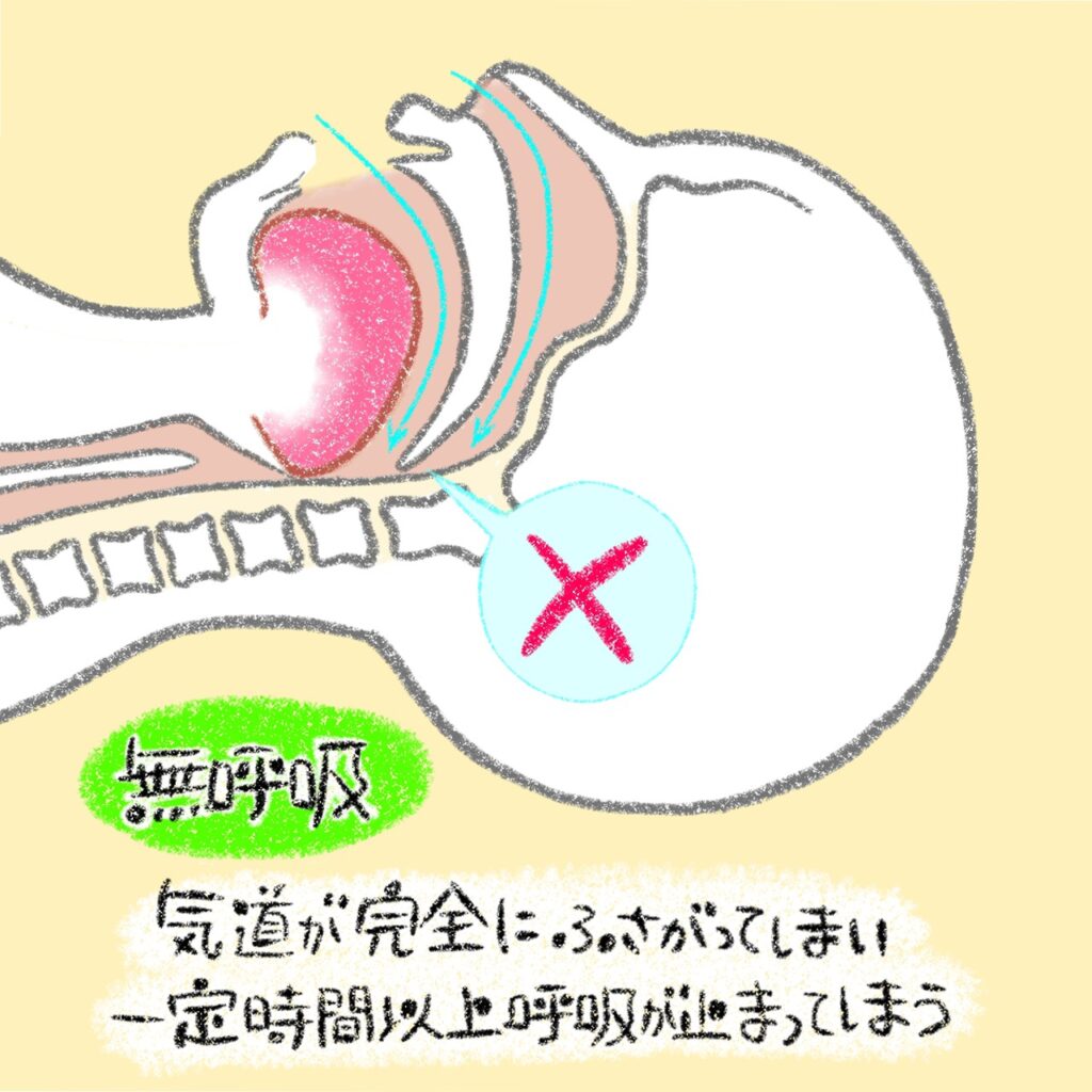 こどもと女性の歯科クリニック 睡眠時無呼吸の時の空気の流れ