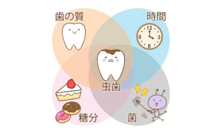歯の質・時間・糖分・菌が組み合わさって虫歯ができる仕組みを示したイラスト