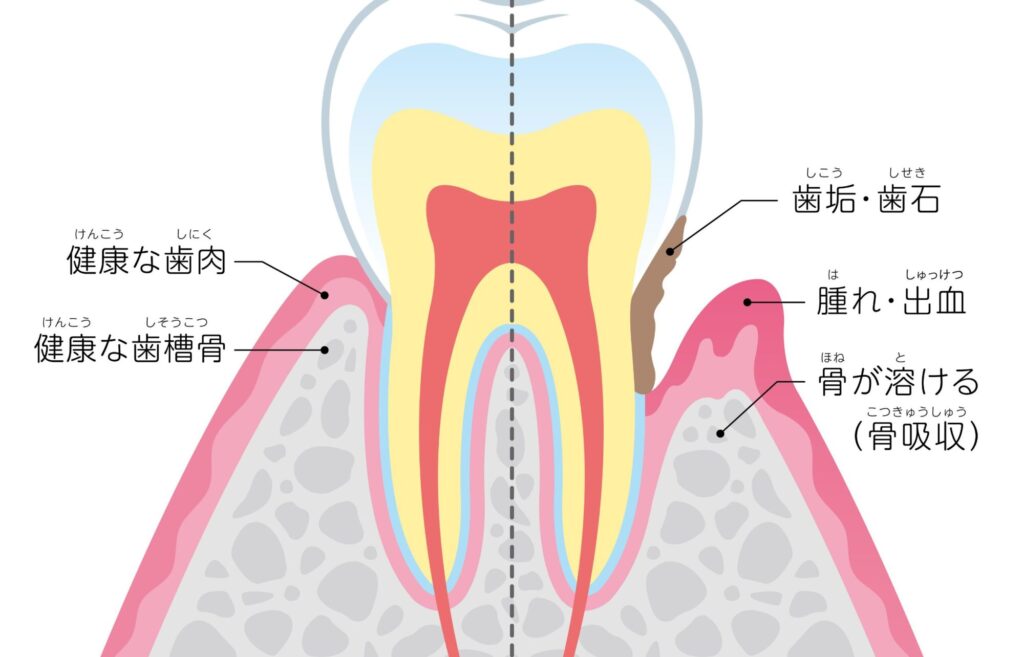 歯の構造を示すイラスト