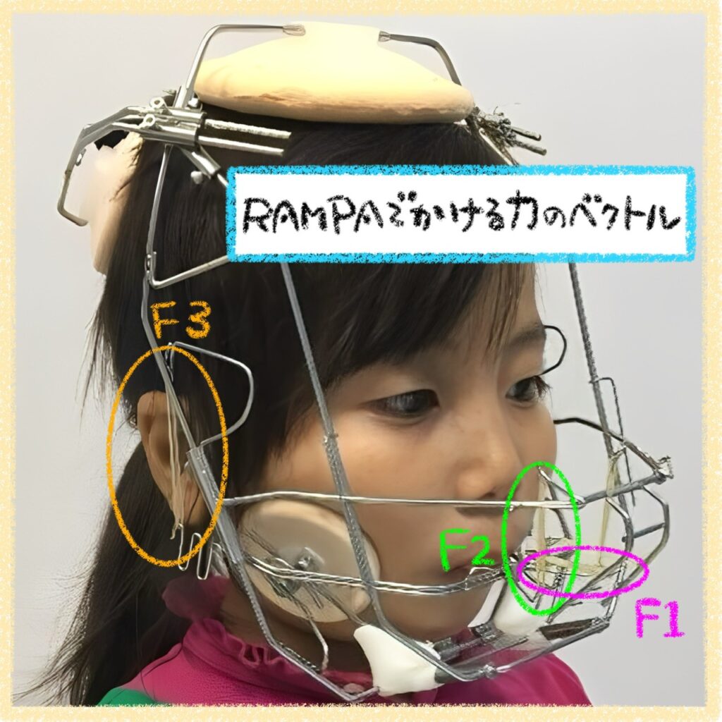 こどもと女性の歯科クリニック RAMPA(ランパ)の装置が引き出す力のベクトル
