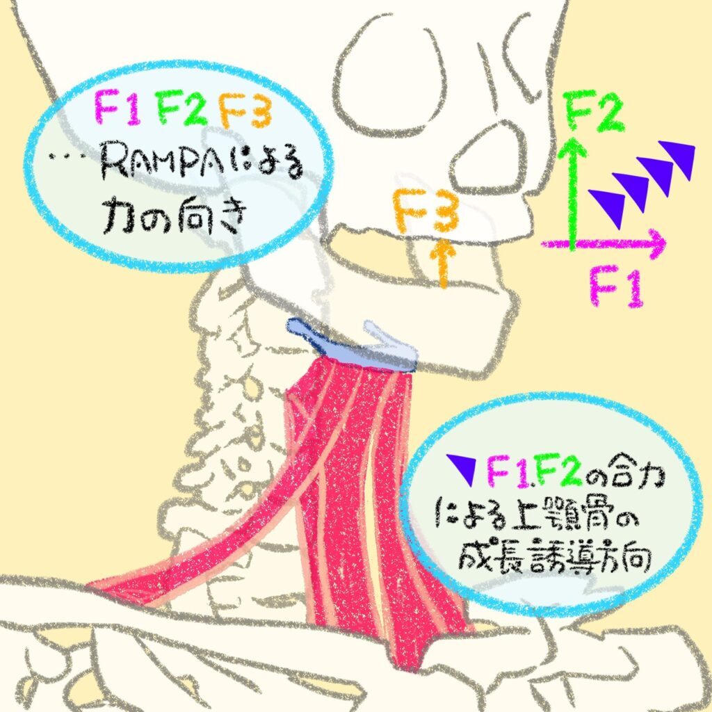 RAMPAの装置が上顎にかける力のベクトルを示すイラスト