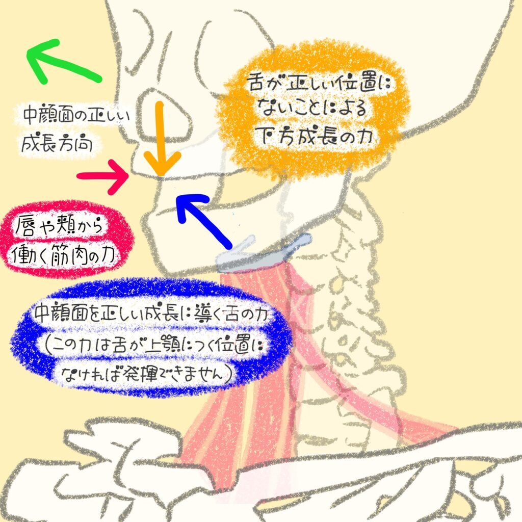 こどもと女性の歯科クリニック 舌が上顎につかない(口呼吸)ことによる骨格への影響を示すイラスト