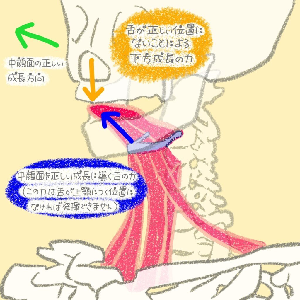 舌が上顎につかない（口呼吸）ことによる骨格への影響