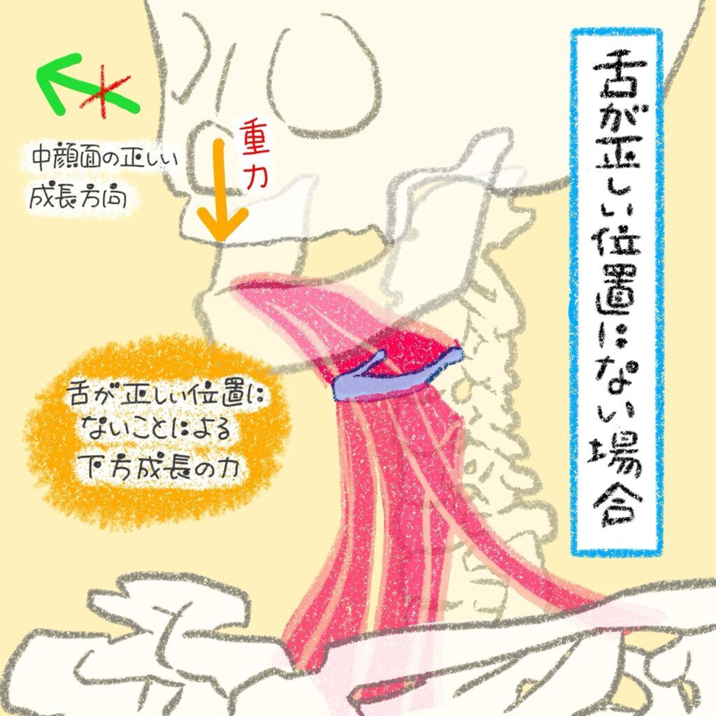 舌が正しい位置にない（口呼吸）場合の骨格の正しくない成長を示すイラスト