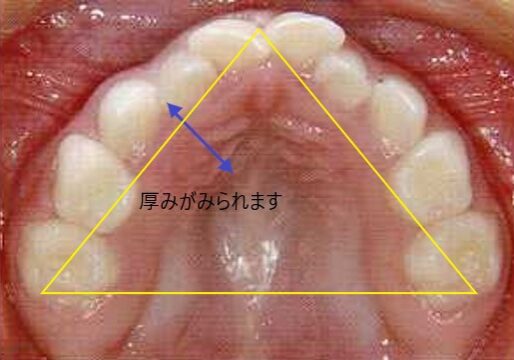 口呼吸の結果、三角の顎に育ったしまった上顎
