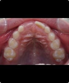 RAMPA診断・検査時。歯と歯の間に隙間がありません。三角形に近い形の顎になっています。　